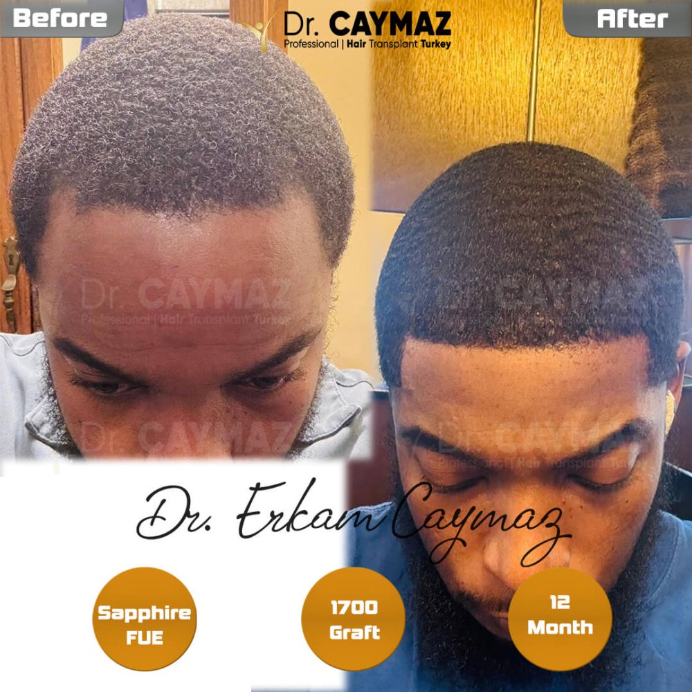12 Month - 1800 Graft - Afro American Result — hair transplant before & after — frontal, 1,800 grafts, Sapphire FUE, 12 months post-op, Norwood 2 — Dr. Erkam Caymaz, Istanbul