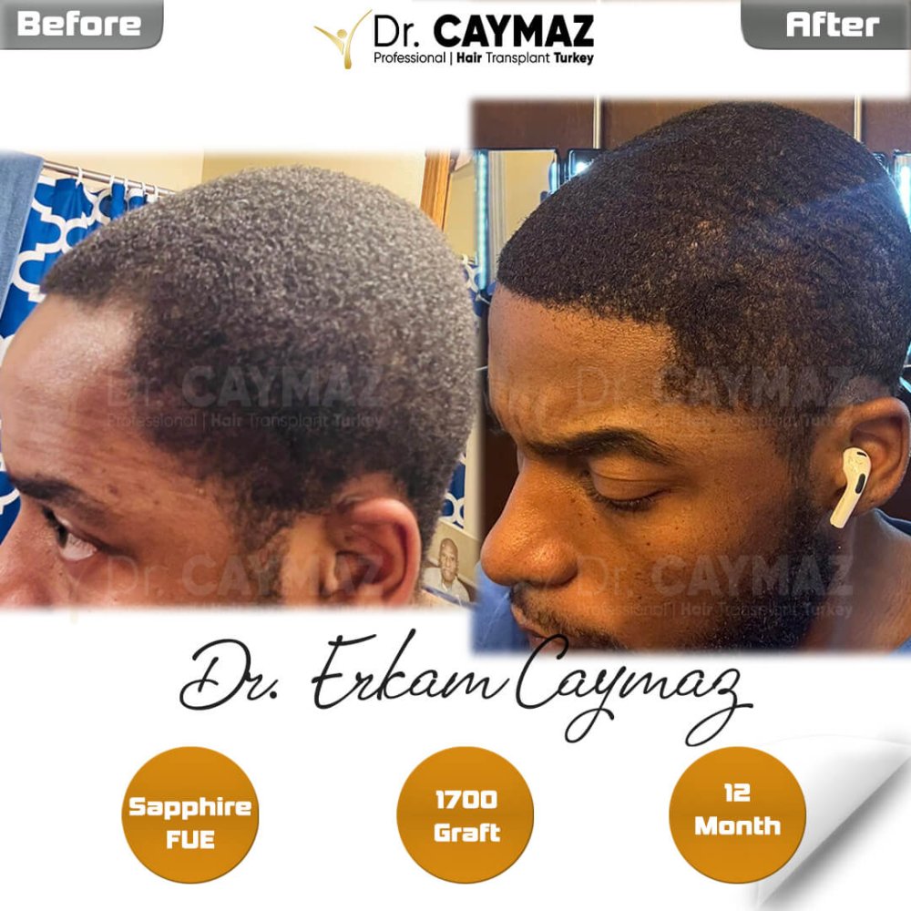 12 Month - 1800 Graft - Afro American Result — hair transplant before & after — frontal, 1,800 grafts, Sapphire FUE, 12 months post-op, Norwood 2 — Dr. Erkam Caymaz, Istanbul