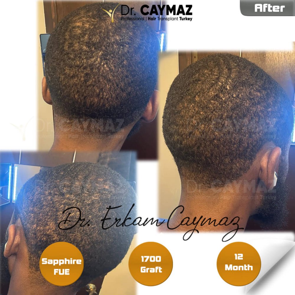 12 Month - 1800 Graft - Afro American Result — hair transplant before & after — frontal, 1,800 grafts, Sapphire FUE, 12 months post-op, Norwood 2 — Dr. Erkam Caymaz, Istanbul