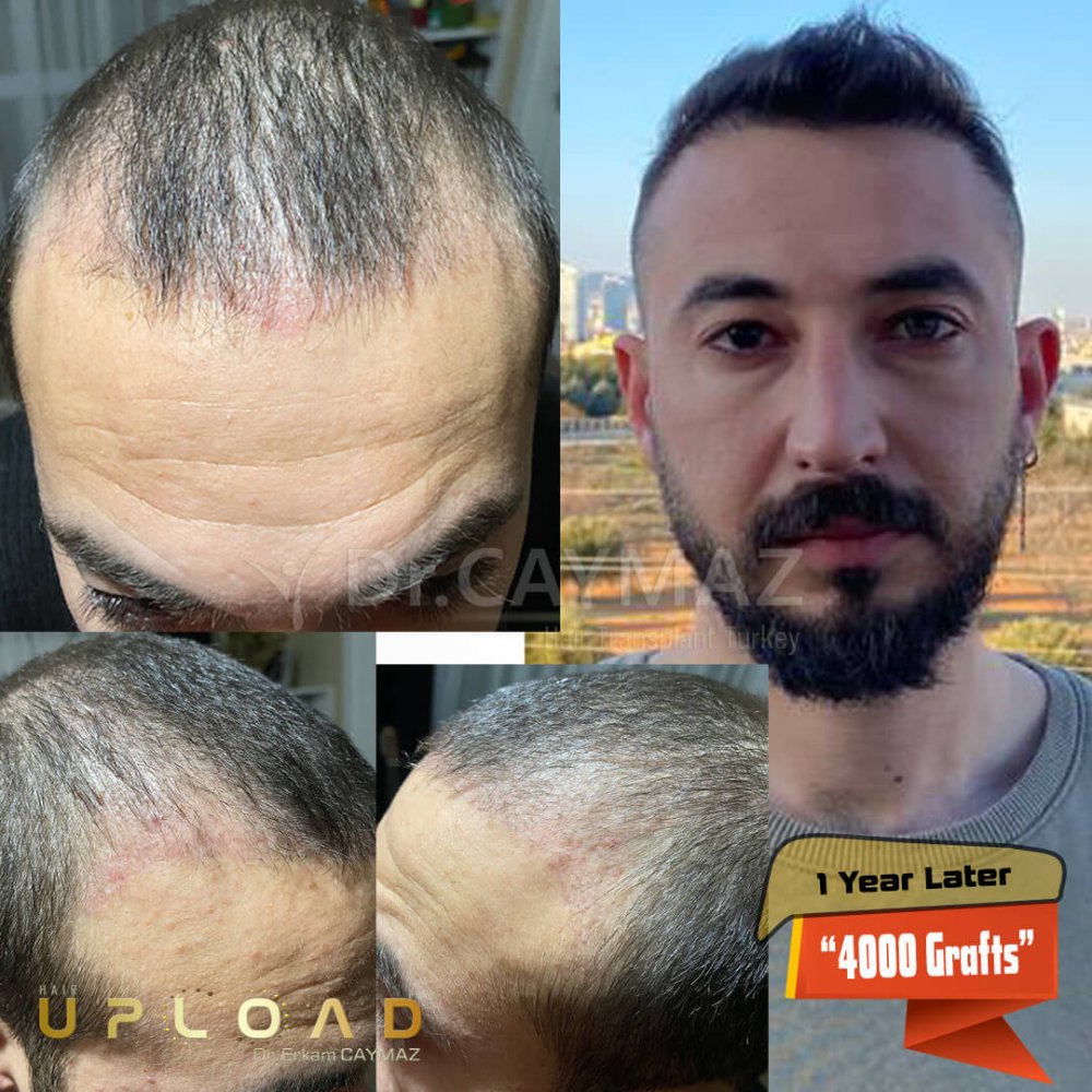 Hair transplant before & after result — frontal, parte superior, 4,000 grafts, Sapphire FUE, 12 months post-op, Norwood 4 — Dr. Erkam Caymaz, Istanbul