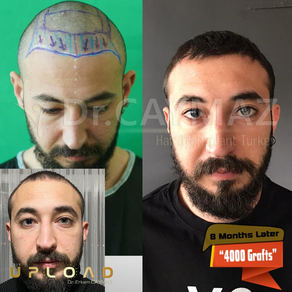Hair transplant before & after result — frontal, parte superior, 4,000 grafts, Sapphire FUE, 12 months post-op, Norwood 4 — Dr. Erkam Caymaz, Istanbul