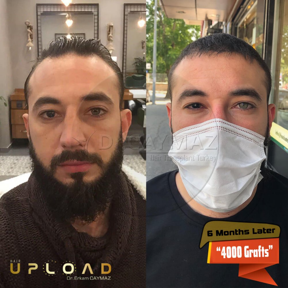 Hair transplant before & after result — frontal, parte superior, 4,000 grafts, Sapphire FUE, 12 months post-op, Norwood 4 — Dr. Erkam Caymaz, Istanbul