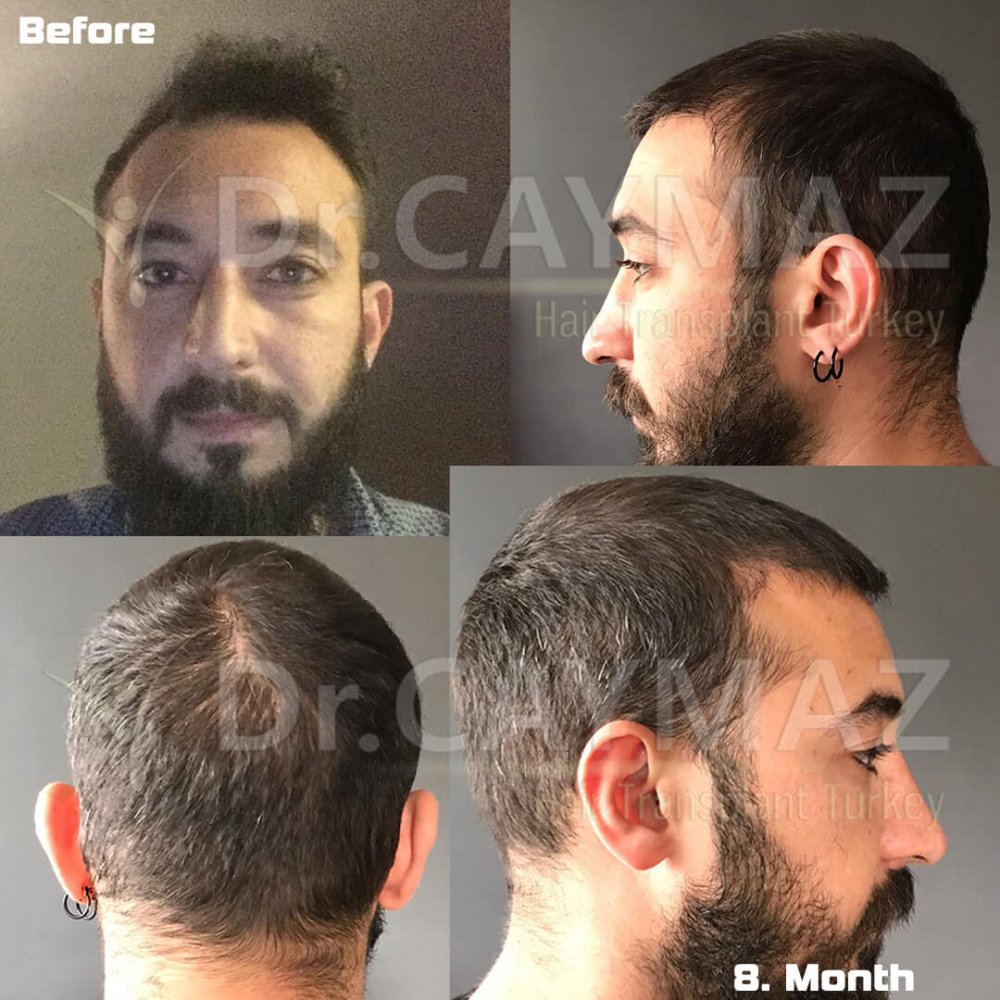 Hair transplant before & after result — frontal, parte superior, 4,000 grafts, Sapphire FUE, 12 months post-op, Norwood 4 — Dr. Erkam Caymaz, Istanbul