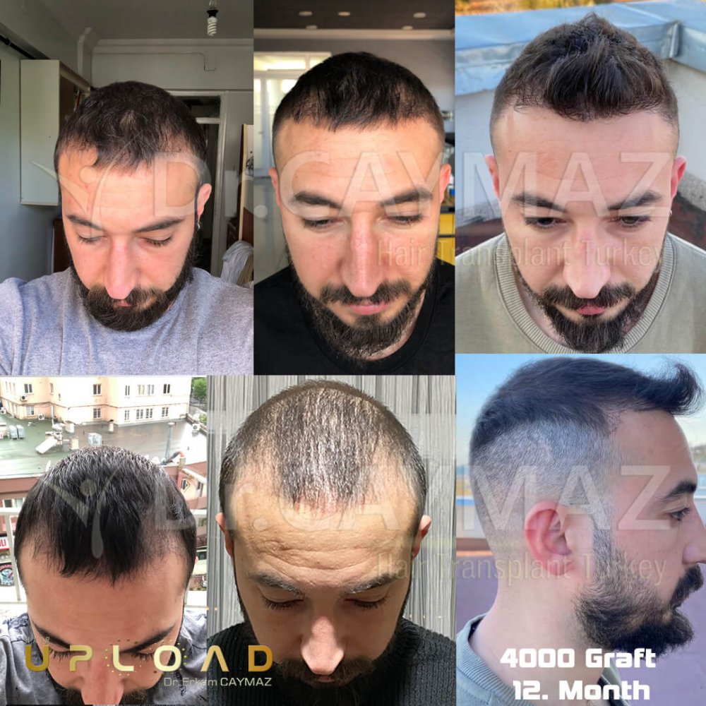 Hair transplant before & after result — frontal, parte superior, 4,000 grafts, Sapphire FUE, 12 months post-op, Norwood 4 — Dr. Erkam Caymaz, Istanbul