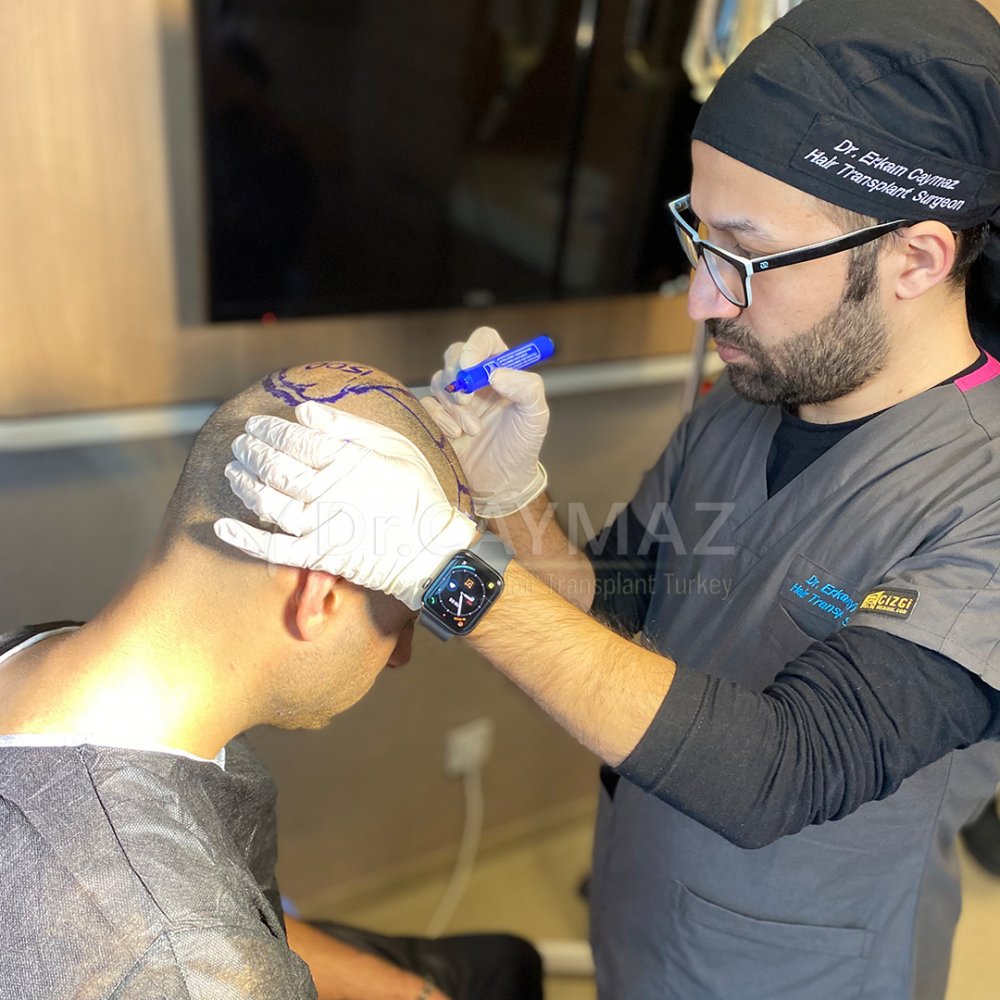 Hair transplant before & after result — frontal, corona, 4,000 grafts, Sapphire FUE, 8 months post-op, Norwood 5 — Dr. Erkam Caymaz, Istanbul