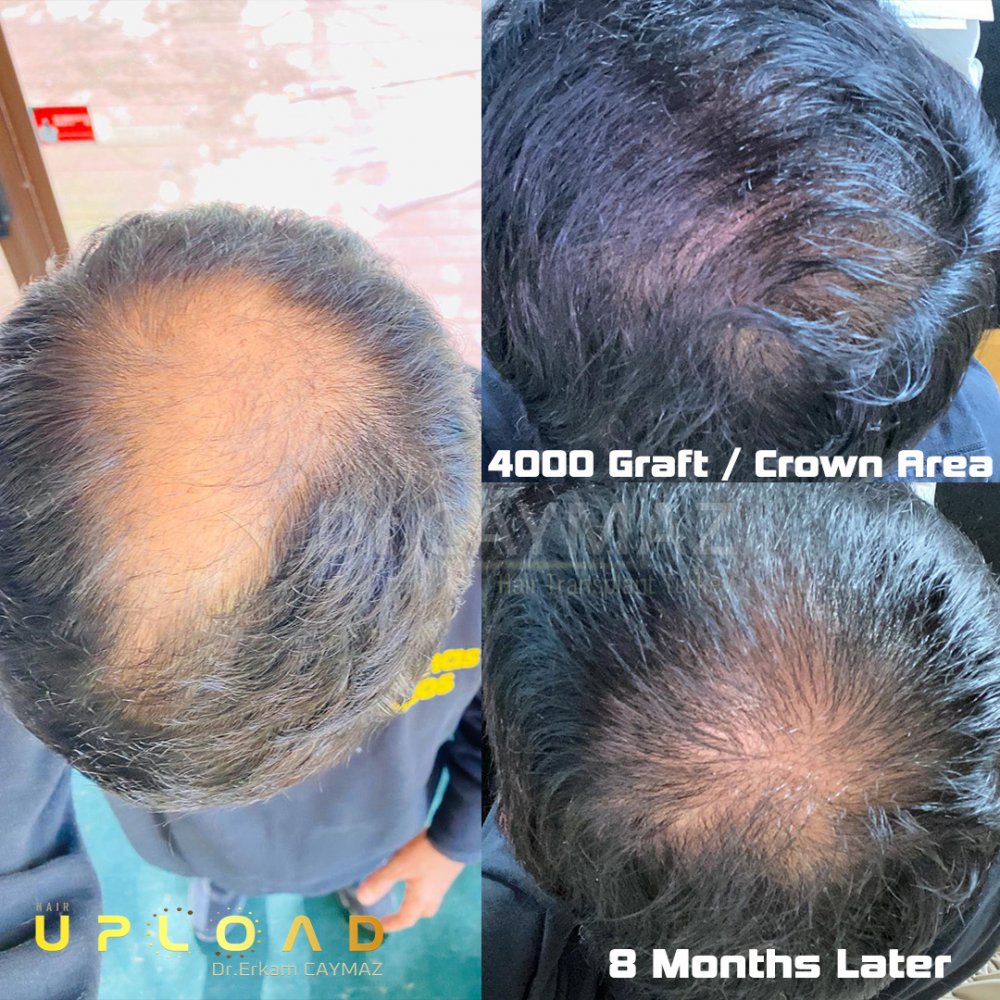 Hair transplant before & after result — frontal, corona, 4,000 grafts, Sapphire FUE, 8 months post-op, Norwood 5 — Dr. Erkam Caymaz, Istanbul