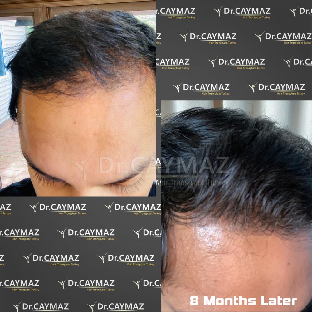 Hair transplant before & after result — frontal, corona, 4,000 grafts, Sapphire FUE, 8 months post-op, Norwood 5 — Dr. Erkam Caymaz, Istanbul