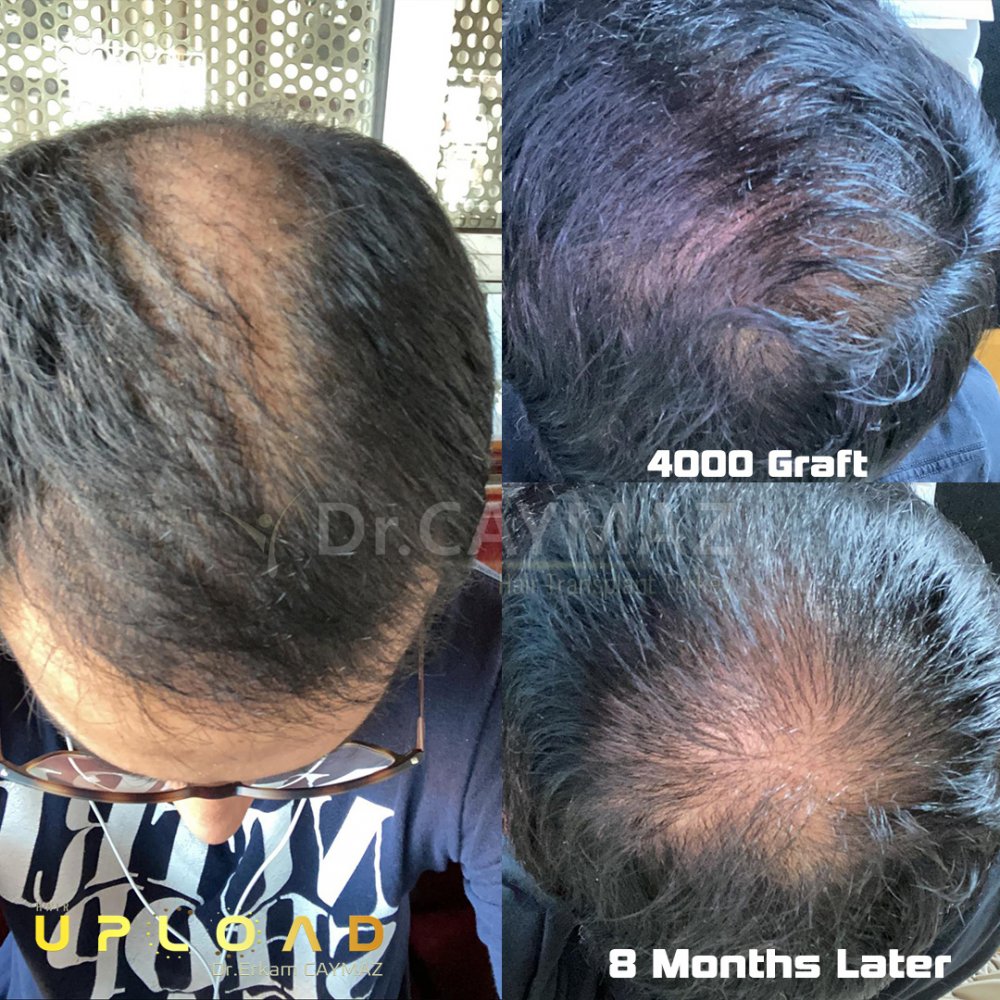 Hair transplant before & after result — frontal, corona, 4,000 grafts, Sapphire FUE, 8 months post-op, Norwood 5 — Dr. Erkam Caymaz, Istanbul
