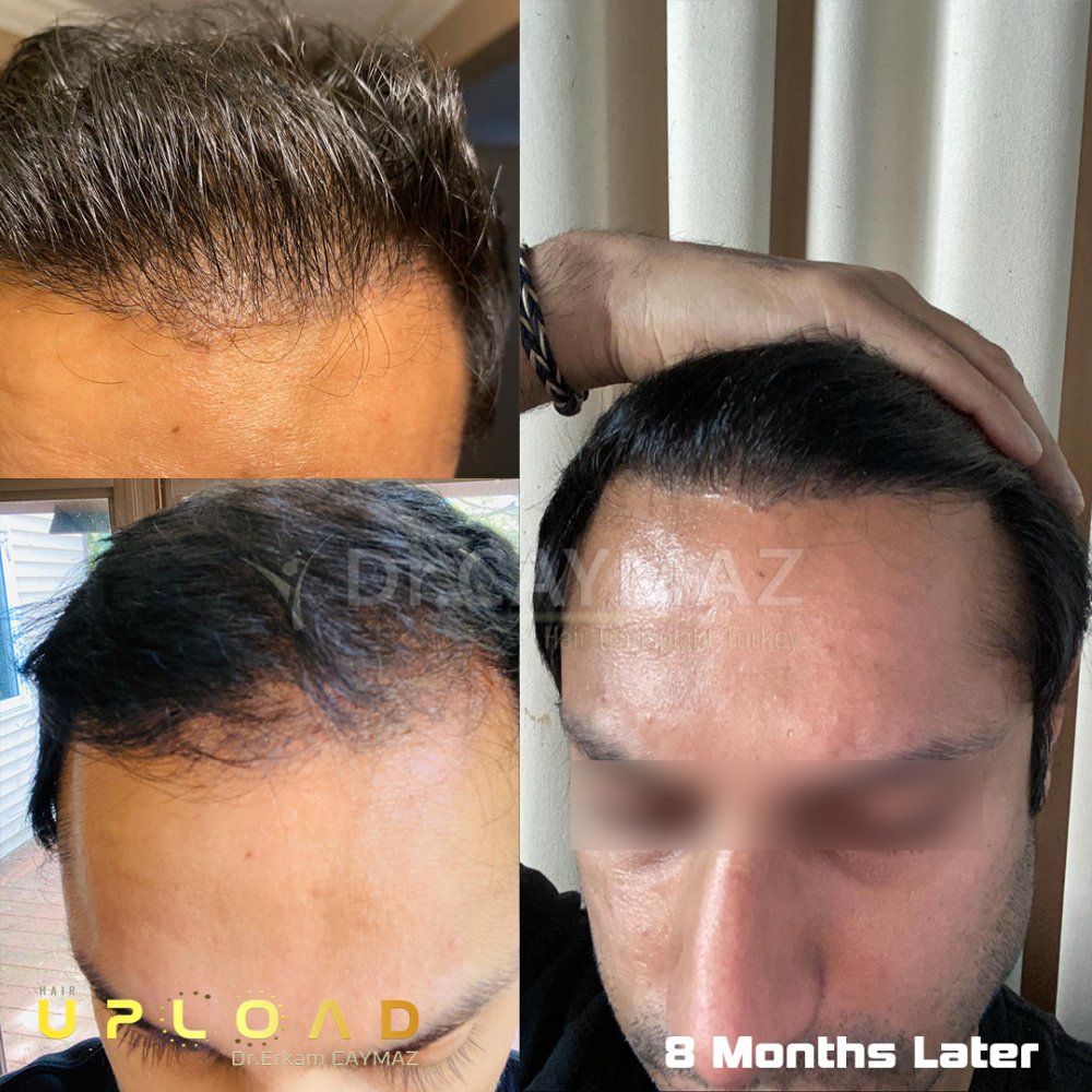 Hair transplant before & after result — frontal, corona, 4,000 grafts, Sapphire FUE, 8 months post-op, Norwood 5 — Dr. Erkam Caymaz, Istanbul