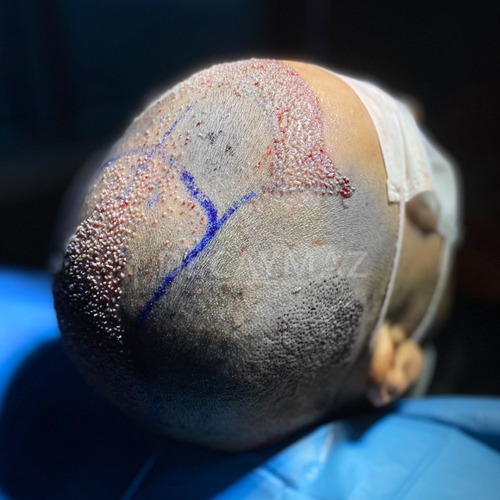 Hair transplant before & after result — frontal, corona, 4,000 grafts, Sapphire FUE, 8 months post-op, Norwood 5 — Dr. Erkam Caymaz, Istanbul