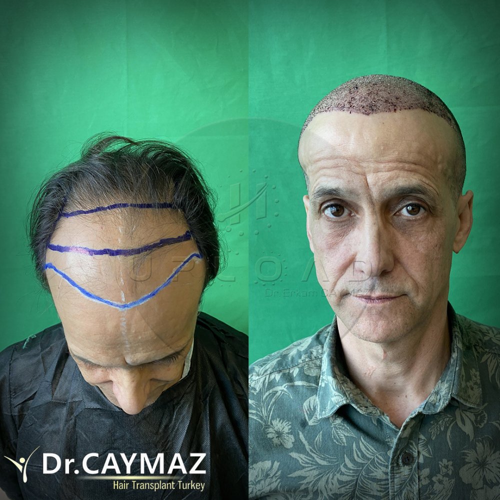 Hair transplant before & after result — frontal, parte superior, corona, 4,500 grafts, Sapphire FUE, 10 months post-op, Norwood 5 — Dr. Erkam Caymaz, Istanbul
