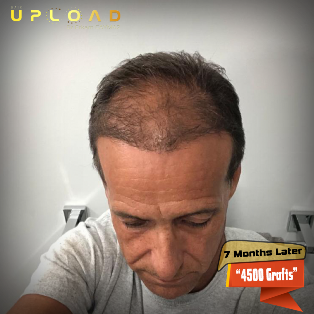 Hair transplant before & after result — frontal, parte superior, corona, 4,500 grafts, Sapphire FUE, 10 months post-op, Norwood 5 — Dr. Erkam Caymaz, Istanbul