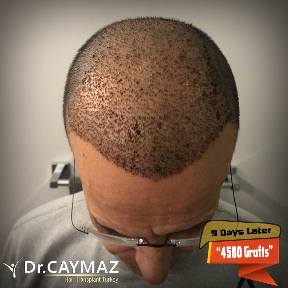 Hair transplant before & after result — frontal, parte superior, corona, 4,500 grafts, Sapphire FUE, 10 months post-op, Norwood 5 — Dr. Erkam Caymaz, Istanbul