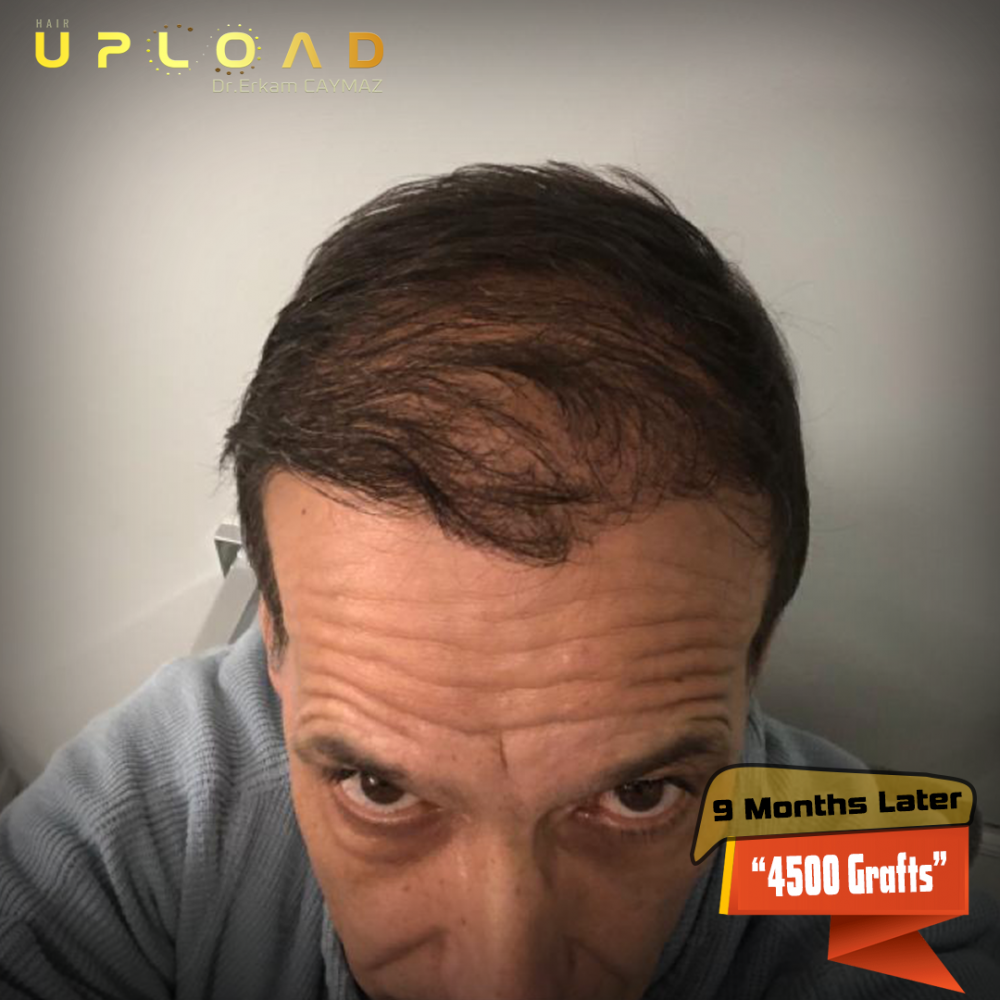 Hair transplant before & after result — frontal, parte superior, corona, 4,500 grafts, Sapphire FUE, 10 months post-op, Norwood 5 — Dr. Erkam Caymaz, Istanbul
