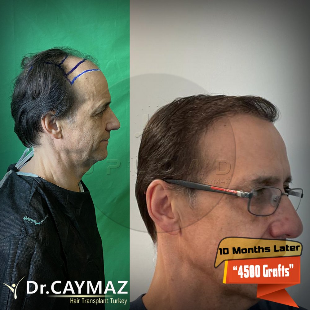 Hair transplant before & after result — frontal, parte superior, corona, 4,500 grafts, Sapphire FUE, 10 months post-op, Norwood 5 — Dr. Erkam Caymaz, Istanbul