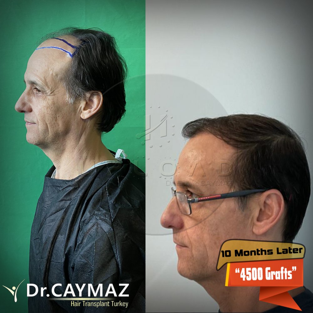 Hair transplant before & after result — frontal, parte superior, corona, 4,500 grafts, Sapphire FUE, 10 months post-op, Norwood 5 — Dr. Erkam Caymaz, Istanbul