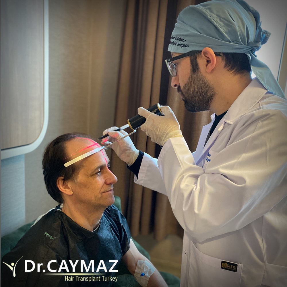 Hair transplant before & after result — frontal, parte superior, corona, 4,500 grafts, Sapphire FUE, 10 months post-op, Norwood 5 — Dr. Erkam Caymaz, Istanbul