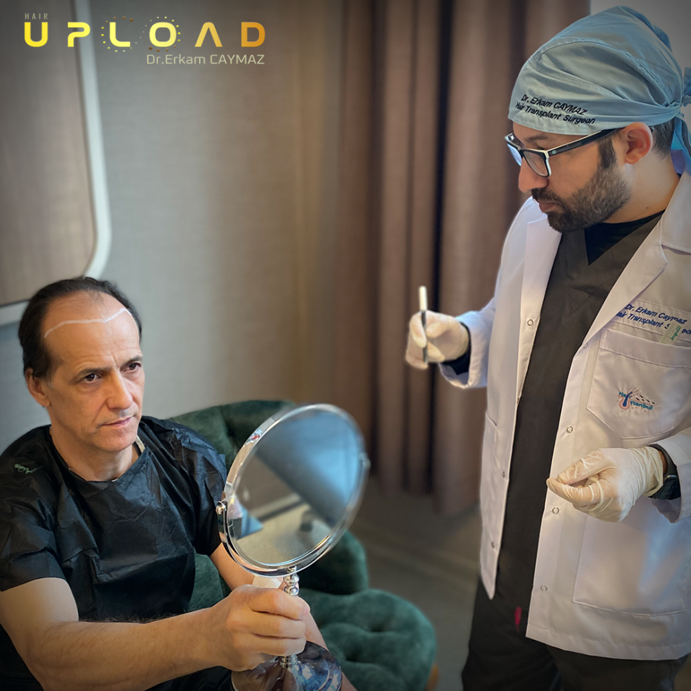 Hair transplant before & after result — frontal, parte superior, corona, 4,500 grafts, Sapphire FUE, 10 months post-op, Norwood 5 — Dr. Erkam Caymaz, Istanbul