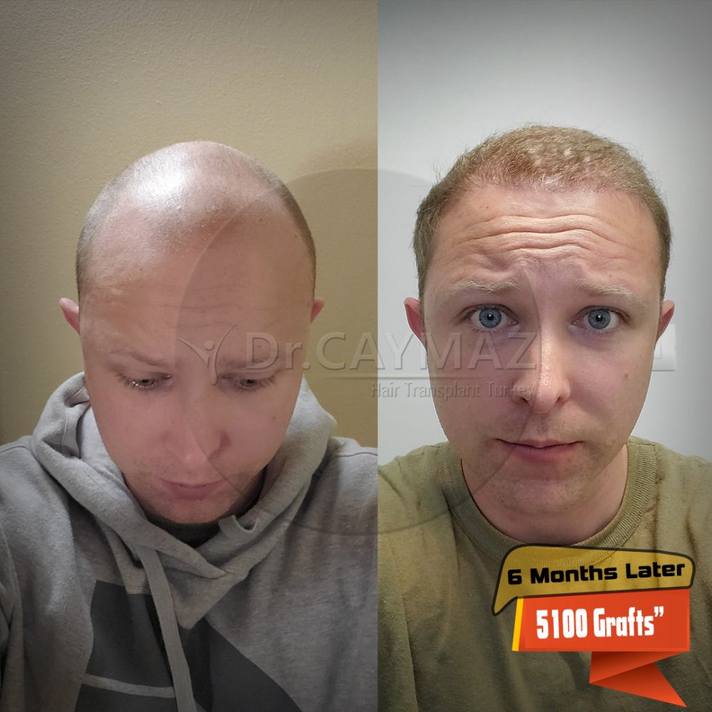 Hair transplant before & after result — frontal, parte superior, corona, 5,100 grafts, Sapphire FUE, 6 months post-op, Norwood 6 — Dr. Erkam Caymaz, Istanbul