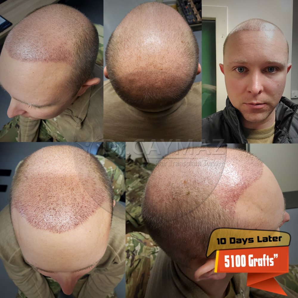 Hair transplant before & after result — frontal, parte superior, corona, 5,100 grafts, Sapphire FUE, 6 months post-op, Norwood 6 — Dr. Erkam Caymaz, Istanbul