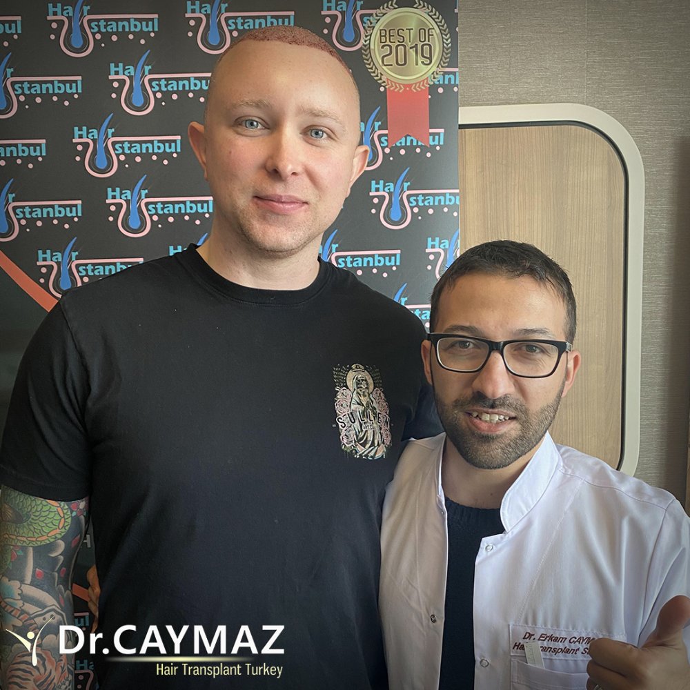 Hair transplant before & after result — frontal, parte superior, corona, 5,100 grafts, Sapphire FUE, 6 months post-op, Norwood 6 — Dr. Erkam Caymaz, Istanbul