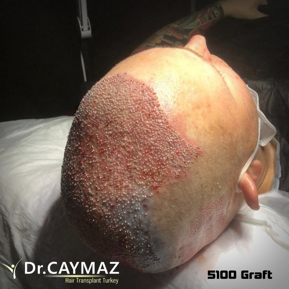 Hair transplant before & after result — frontal, parte superior, corona, 5,100 grafts, Sapphire FUE, 6 months post-op, Norwood 6 — Dr. Erkam Caymaz, Istanbul