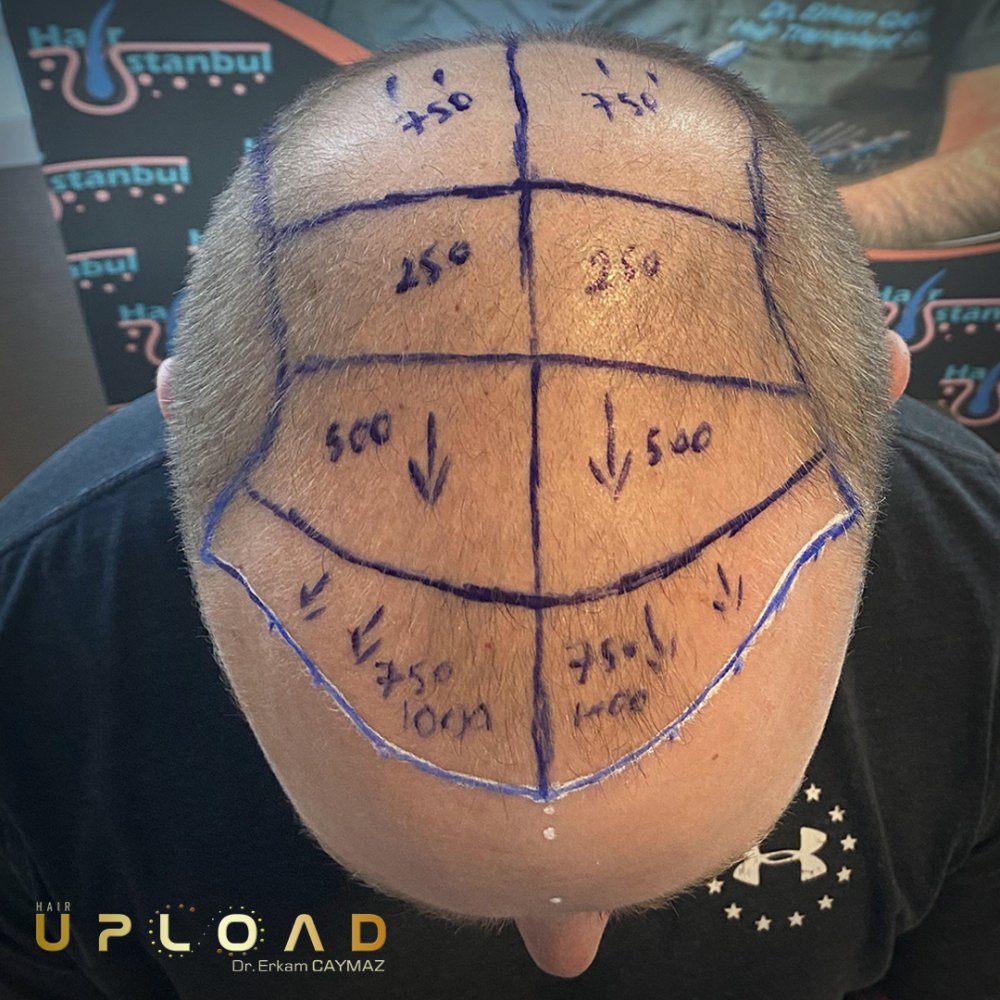 Hair transplant before & after result — frontal, parte superior, corona, 5,100 grafts, Sapphire FUE, 6 months post-op, Norwood 6 — Dr. Erkam Caymaz, Istanbul