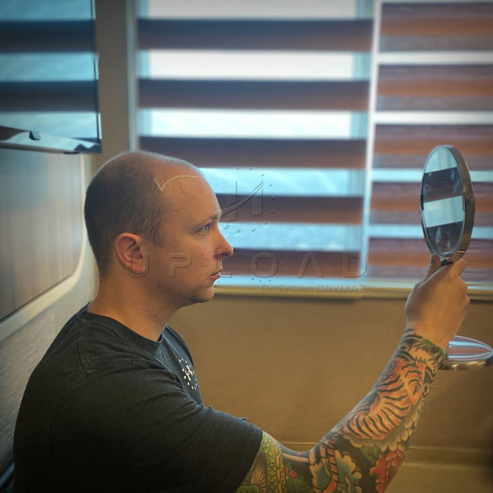 Hair transplant before & after result — frontal, parte superior, corona, 5,100 grafts, Sapphire FUE, 6 months post-op, Norwood 6 — Dr. Erkam Caymaz, Istanbul
