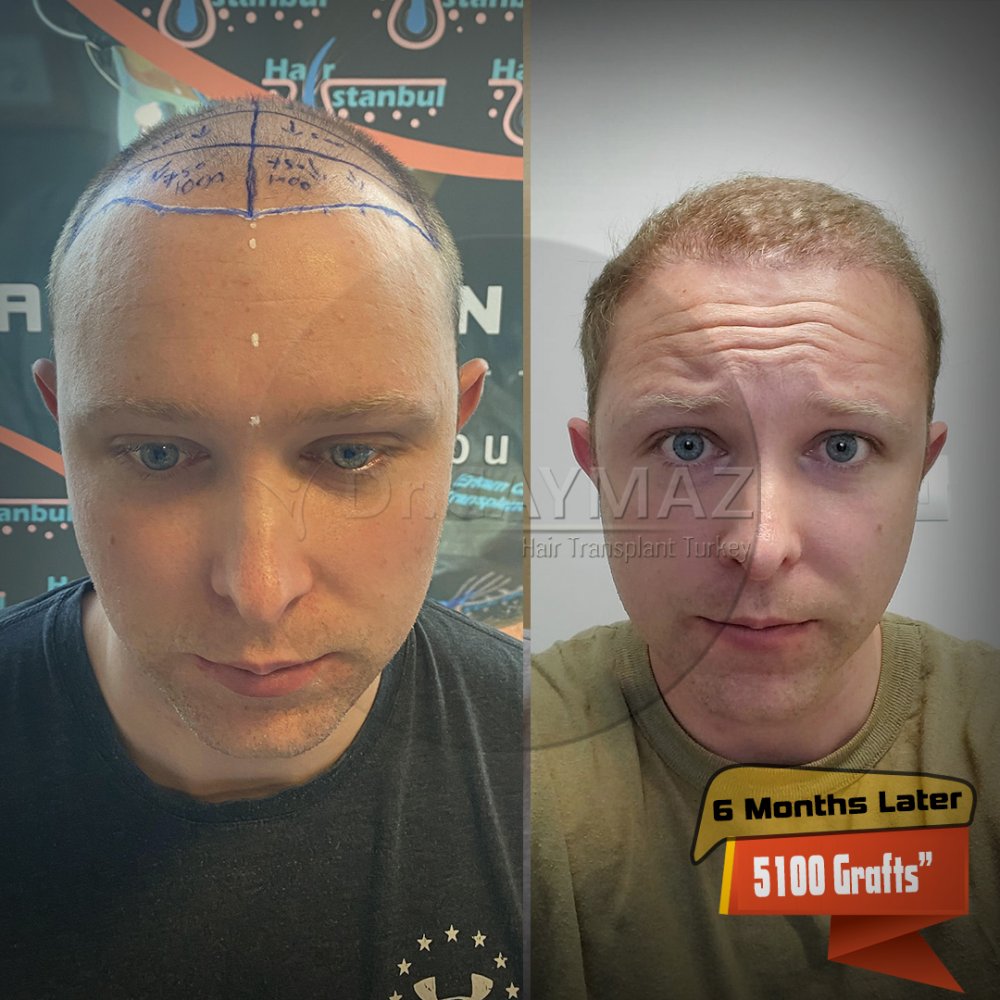Hair transplant before & after result — frontal, parte superior, corona, 5,100 grafts, Sapphire FUE, 6 months post-op, Norwood 6 — Dr. Erkam Caymaz, Istanbul
