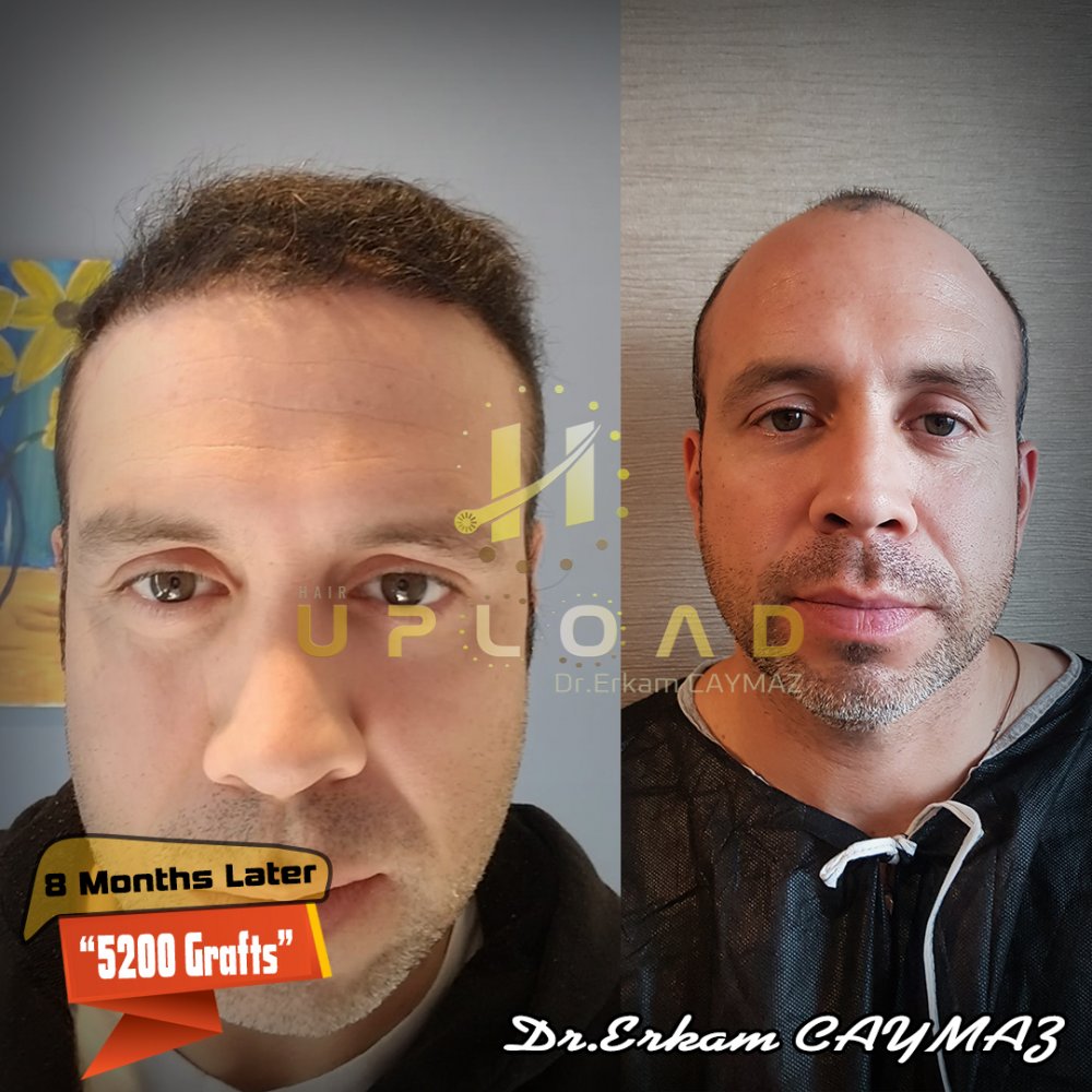 Hair transplant before & after result — frontal, parte superior, corona, 5,200 grafts, Sapphire FUE, 8 months post-op, Norwood 6 — Dr. Erkam Caymaz, Istanbul