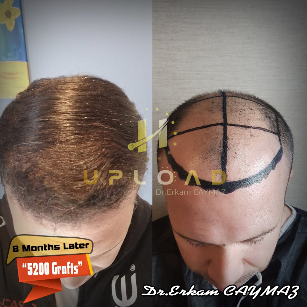 Hair transplant before & after result — frontal, parte superior, corona, 5,200 grafts, Sapphire FUE, 8 months post-op, Norwood 6 — Dr. Erkam Caymaz, Istanbul