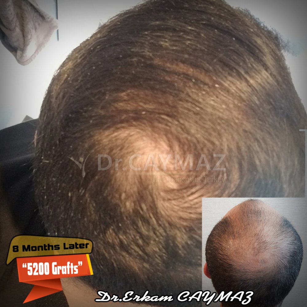 Hair transplant before & after result — frontal, parte superior, corona, 5,200 grafts, Sapphire FUE, 8 months post-op, Norwood 6 — Dr. Erkam Caymaz, Istanbul