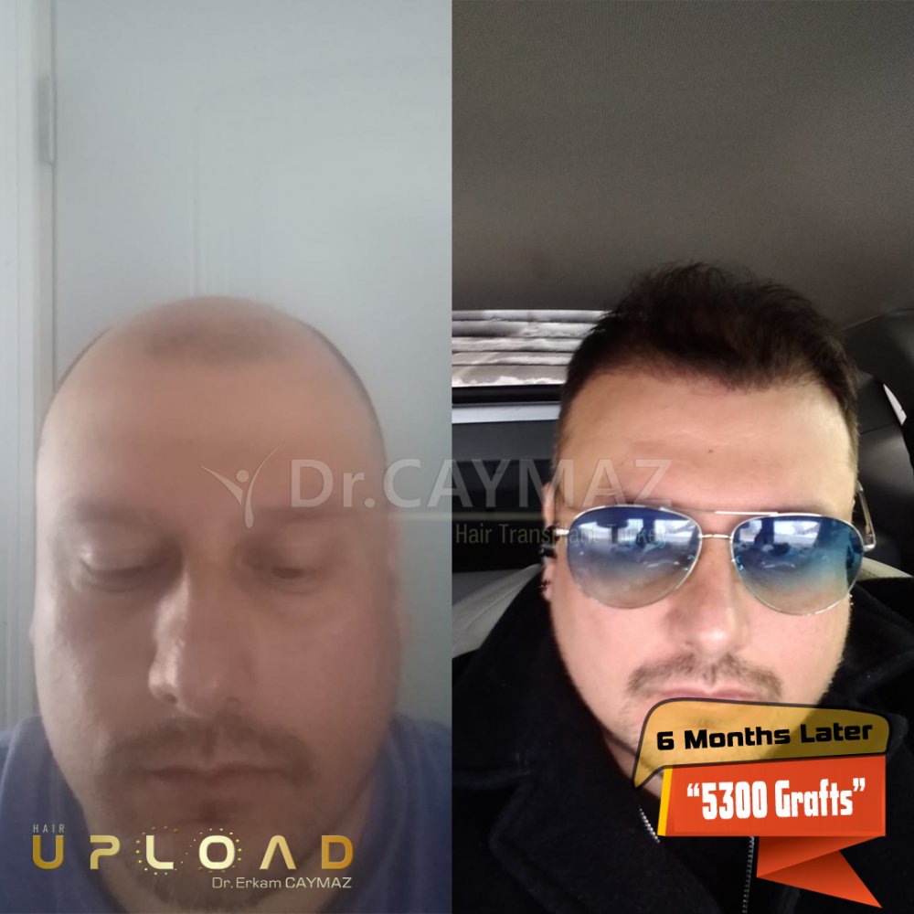 Hair transplant before & after result — frontal, parte superior, corona, 5,300 grafts, Sapphire FUE, 6 months post-op, Norwood 5 — Dr. Erkam Caymaz, Istanbul