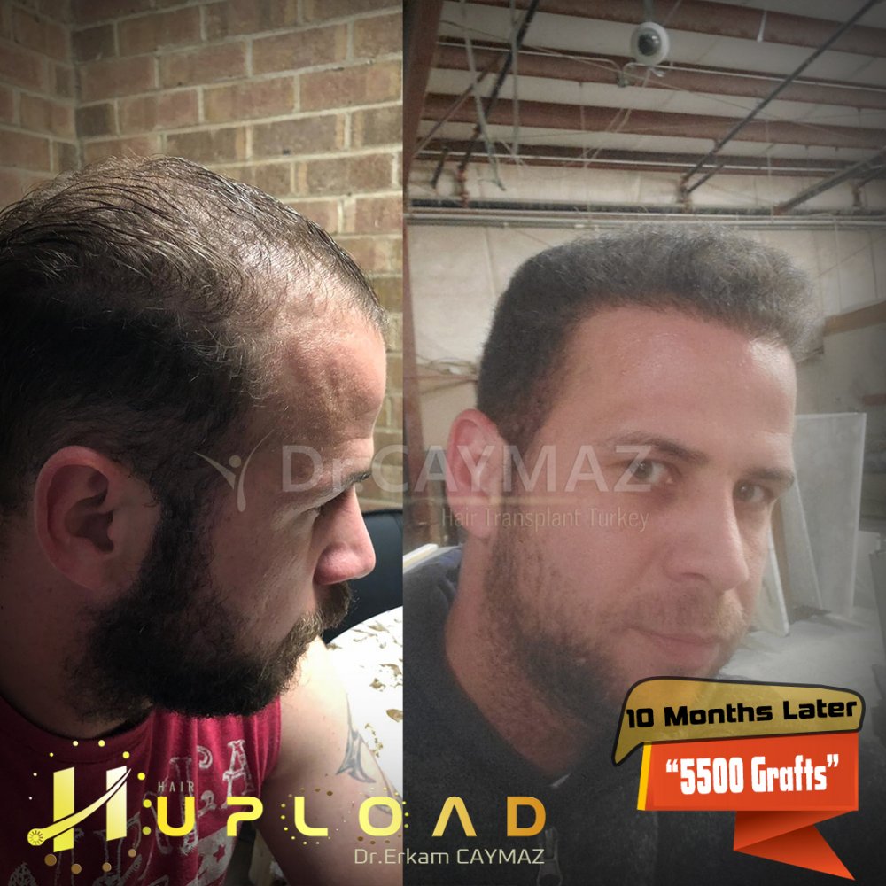 Hair transplant before & after result — frontal, corona, 5,500 grafts, Sapphire FUE, 10 months post-op, Norwood 6 — Dr. Erkam Caymaz, Istanbul