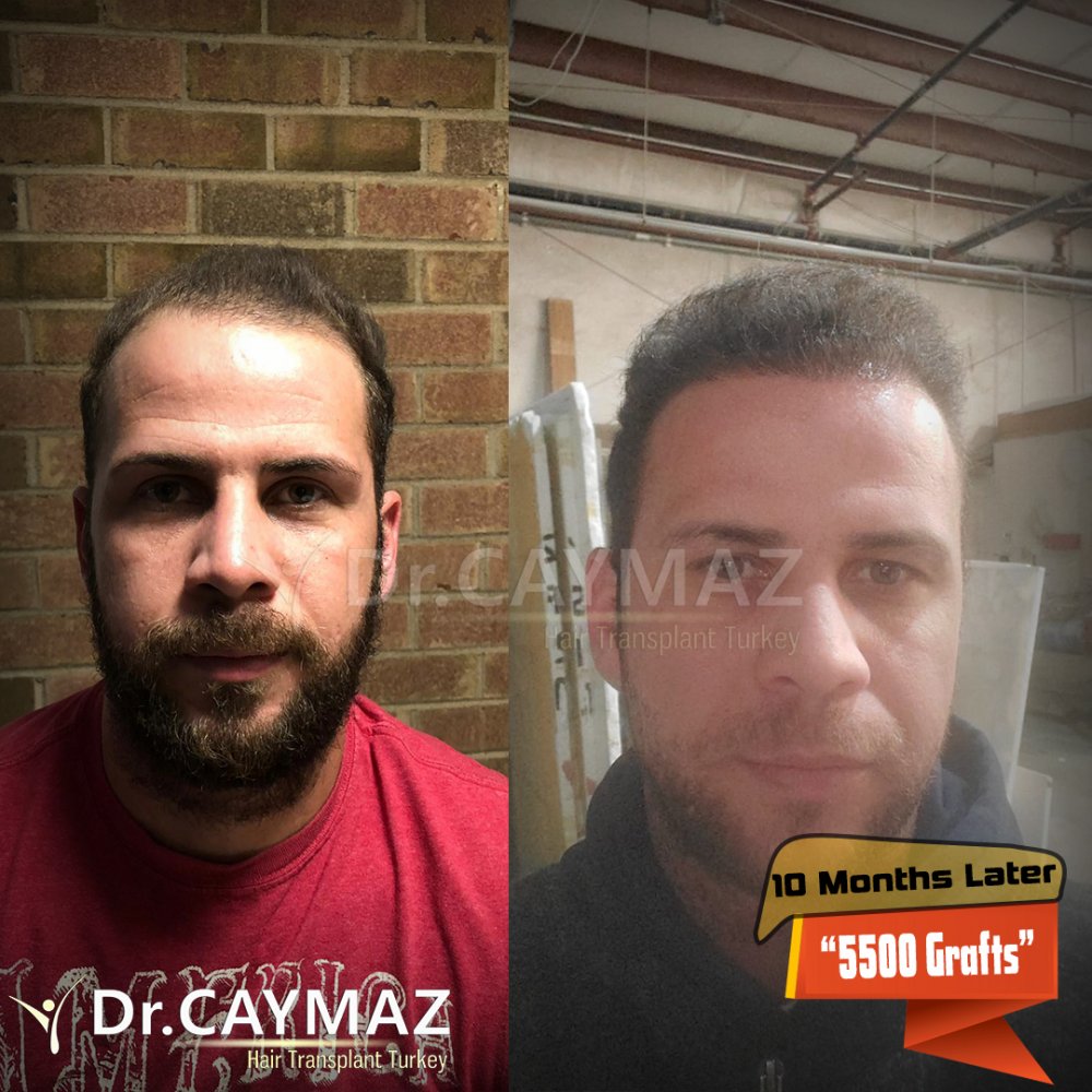 Hair transplant before & after result — frontal, corona, 5,500 grafts, Sapphire FUE, 10 months post-op, Norwood 6 — Dr. Erkam Caymaz, Istanbul