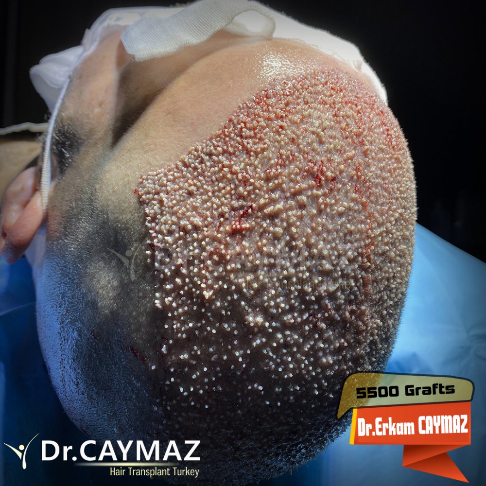 Hair transplant before & after result — frontal, corona, 5,500 grafts, Sapphire FUE, 10 months post-op, Norwood 6 — Dr. Erkam Caymaz, Istanbul