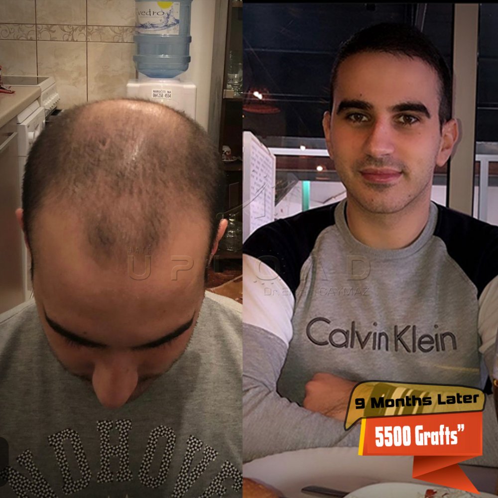 Hair transplant before & after result — frontal, parte superior, corona, 5,500 grafts, Sapphire FUE, 12 months post-op, Norwood 6 — Dr. Erkam Caymaz, Istanbul