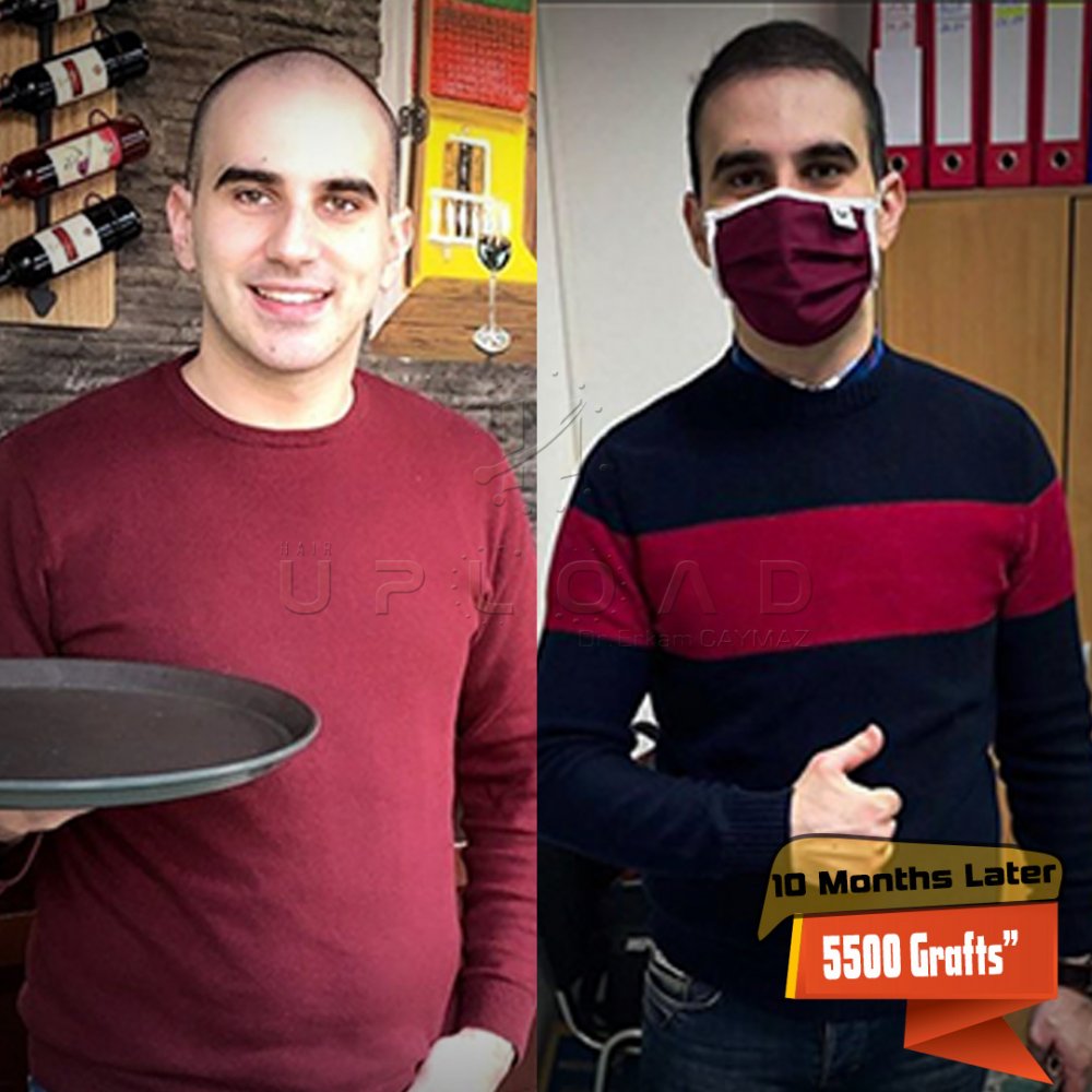 Hair transplant before & after result — frontal, parte superior, corona, 5,500 grafts, Sapphire FUE, 12 months post-op, Norwood 6 — Dr. Erkam Caymaz, Istanbul