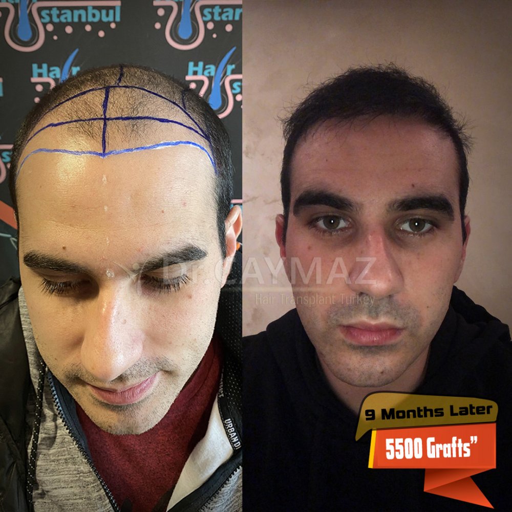 Hair transplant before & after result — frontal, parte superior, corona, 5,500 grafts, Sapphire FUE, 12 months post-op, Norwood 6 — Dr. Erkam Caymaz, Istanbul