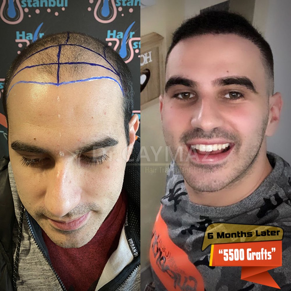Hair transplant before & after result — frontal, parte superior, corona, 5,500 grafts, Sapphire FUE, 12 months post-op, Norwood 6 — Dr. Erkam Caymaz, Istanbul