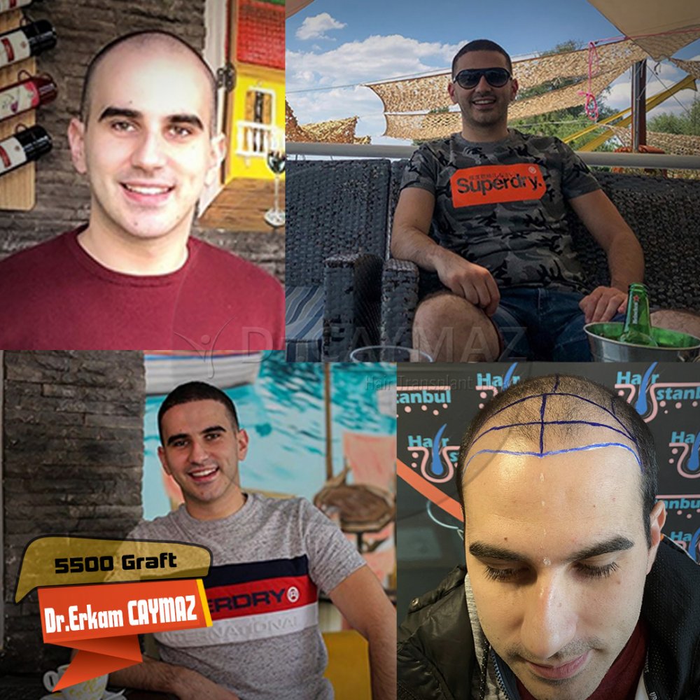 Hair transplant before & after result — frontal, parte superior, corona, 5,500 grafts, Sapphire FUE, 12 months post-op, Norwood 6 — Dr. Erkam Caymaz, Istanbul