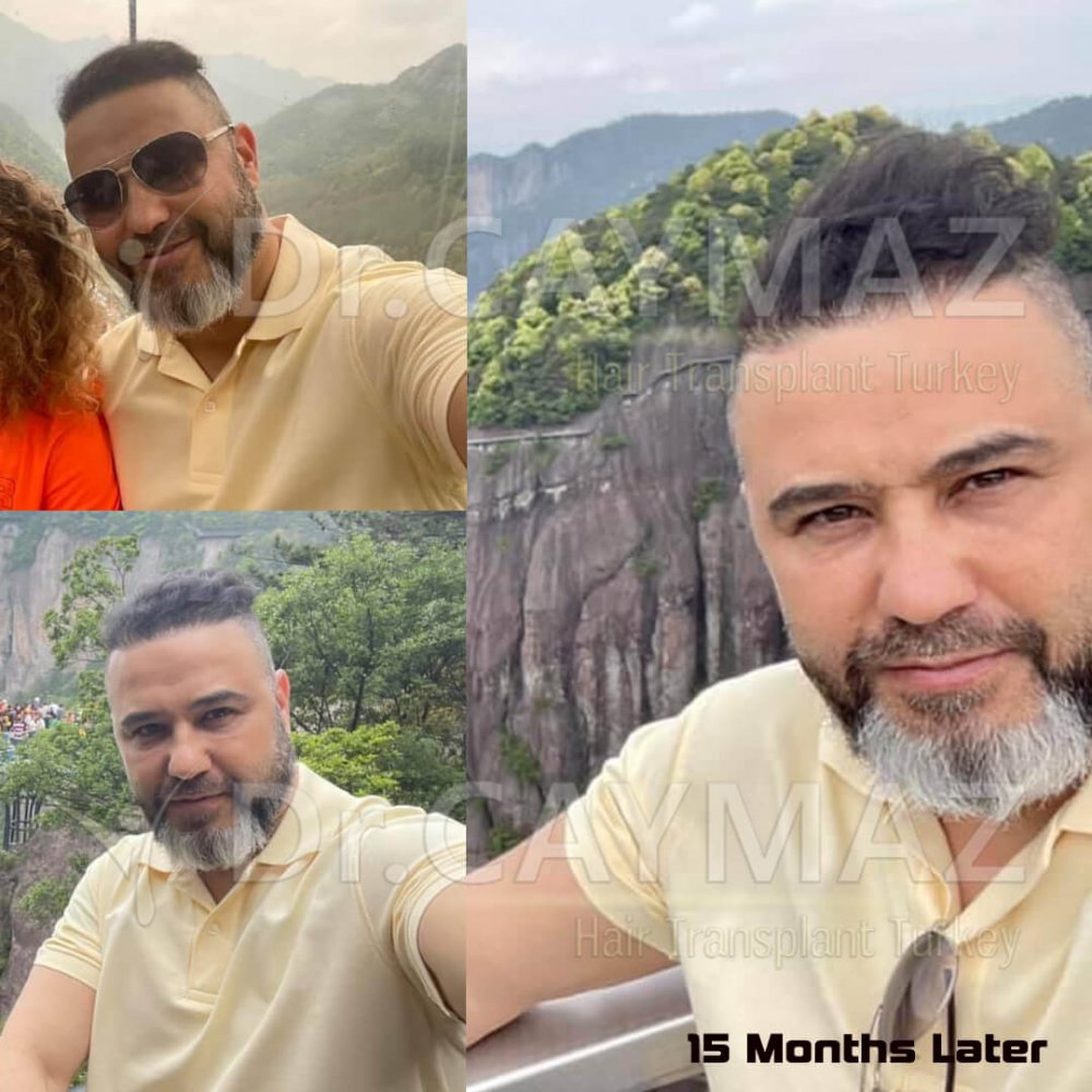 Hair transplant before & after result — frontal, parte superior, corona, 6,000 grafts, Sapphire FUE, 12 months post-op, Norwood 6 — Dr. Erkam Caymaz, Istanbul