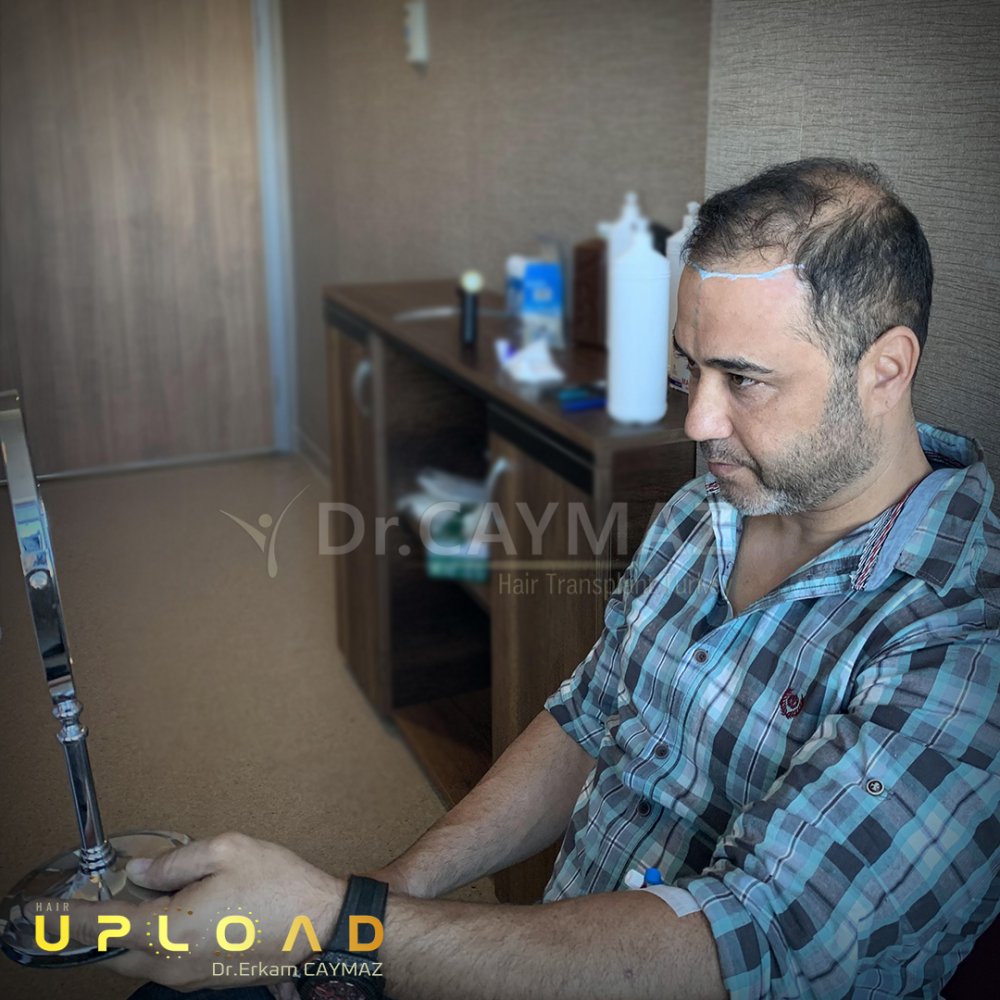 Hair transplant before & after result — frontal, parte superior, corona, 6,000 grafts, Sapphire FUE, 12 months post-op, Norwood 6 — Dr. Erkam Caymaz, Istanbul