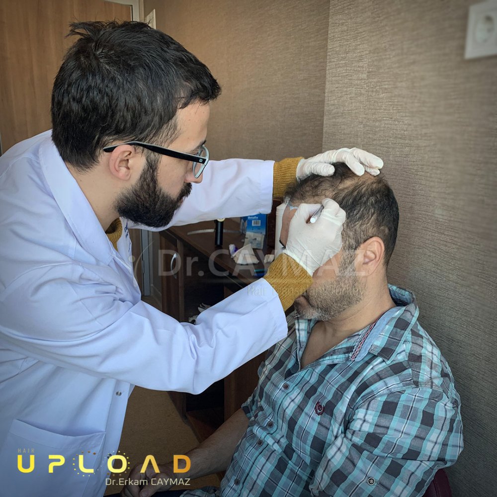 Hair transplant before & after result — frontal, parte superior, corona, 6,000 grafts, Sapphire FUE, 12 months post-op, Norwood 6 — Dr. Erkam Caymaz, Istanbul