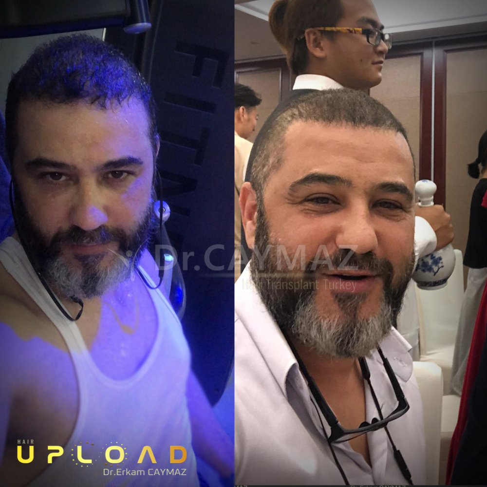 Hair transplant before & after result — frontal, parte superior, corona, 6,000 grafts, Sapphire FUE, 12 months post-op, Norwood 6 — Dr. Erkam Caymaz, Istanbul