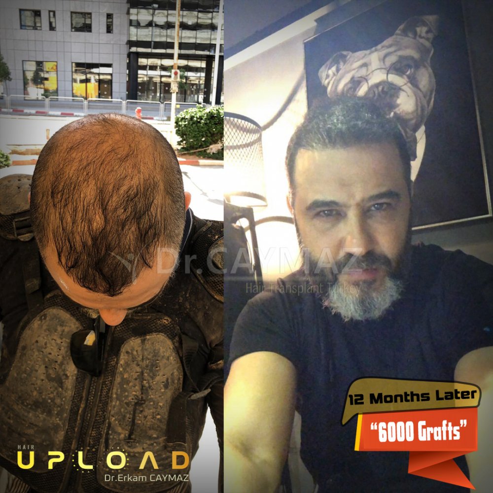 Hair transplant before & after result — frontal, parte superior, corona, 6,000 grafts, Sapphire FUE, 12 months post-op, Norwood 6 — Dr. Erkam Caymaz, Istanbul
