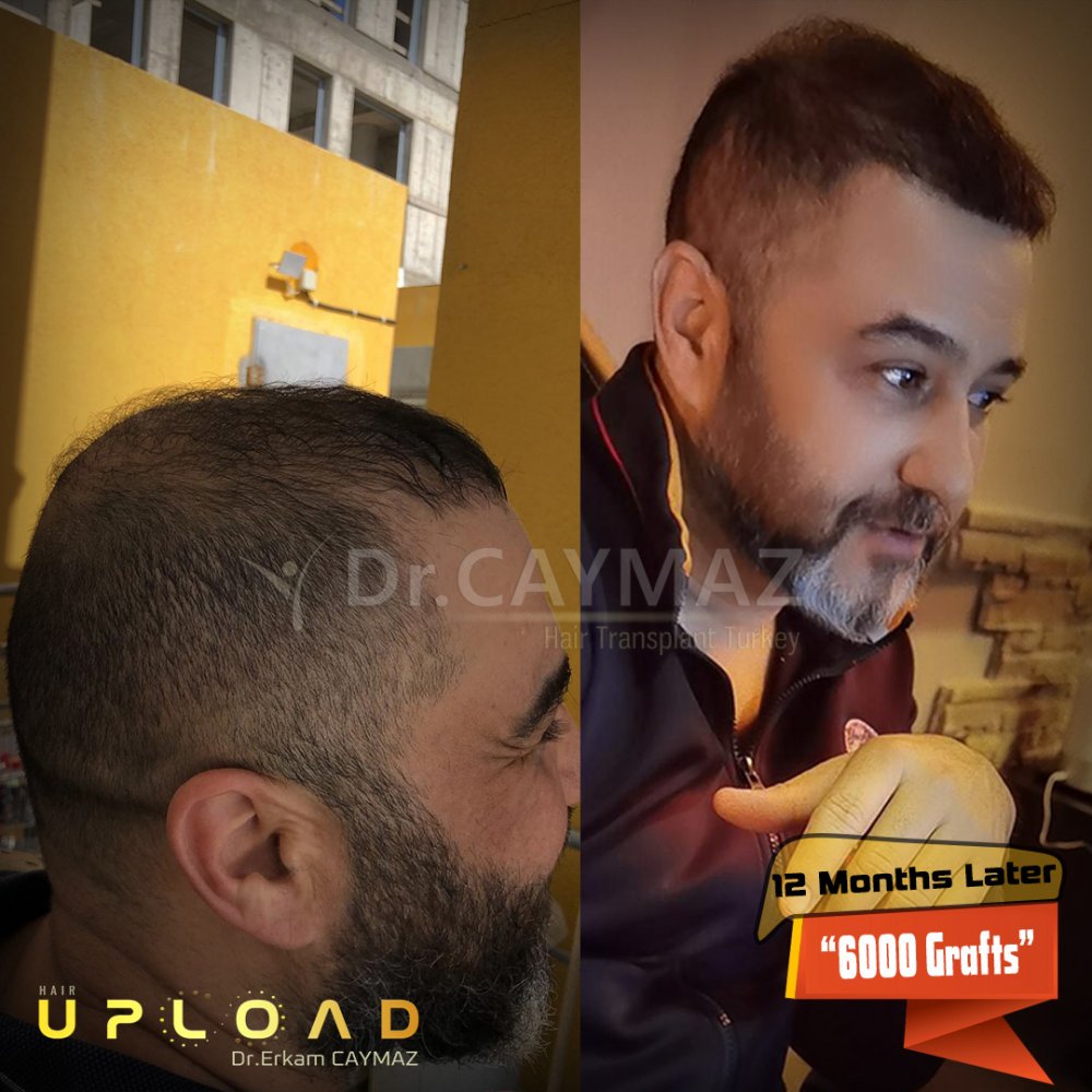 Hair transplant before & after result — frontal, parte superior, corona, 6,000 grafts, Sapphire FUE, 12 months post-op, Norwood 6 — Dr. Erkam Caymaz, Istanbul