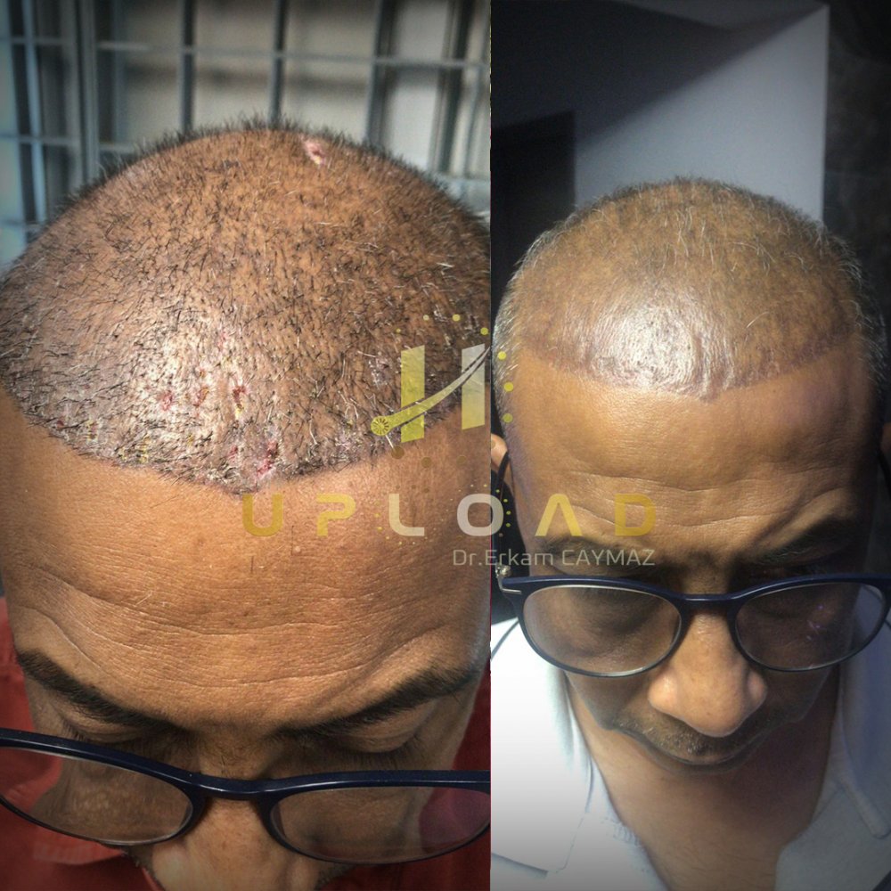 Hair transplant before & after result — frontal, top of head, crown, 6,000 grafts, Sapphire FUE, 24 months post-op, Norwood 6 — Dr. Erkam Caymaz, Istanbul