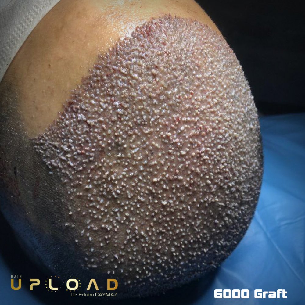 Hair transplant before & after result — frontal, parte superior, corona, 6,000 grafts, Sapphire FUE, 9 months post-op, Norwood 6 — Dr. Erkam Caymaz, Istanbul
