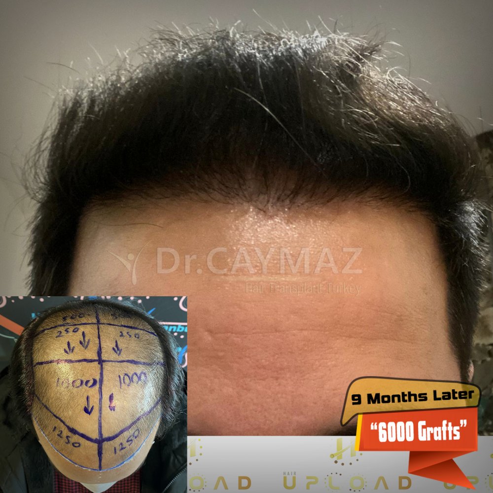 Hair transplant before & after result — frontal, parte superior, corona, 6,000 grafts, Sapphire FUE, 9 months post-op, Norwood 6 — Dr. Erkam Caymaz, Istanbul
